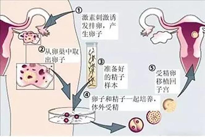 供卵试管过程_供卵试管:孕育生命的奇迹